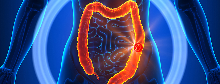 Colorectal Oncology in UAE