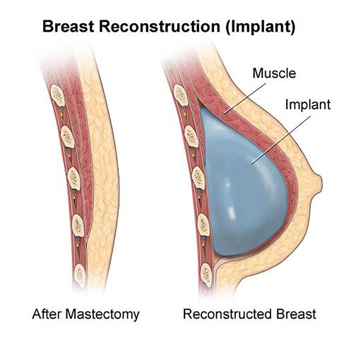 Breast Reconstruction Dubai