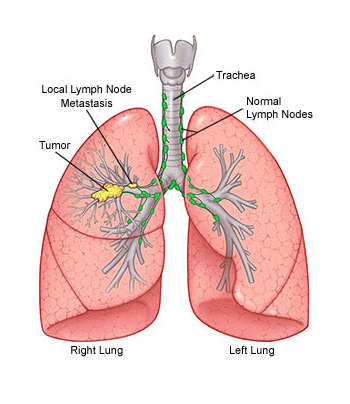 Thoracic Oncology Cancer Dubai