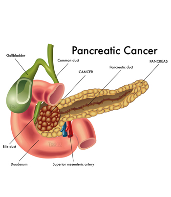 Pancreatic Cancer in Dubai