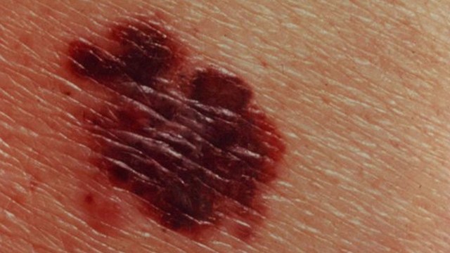 Melanoma Surgery UAE