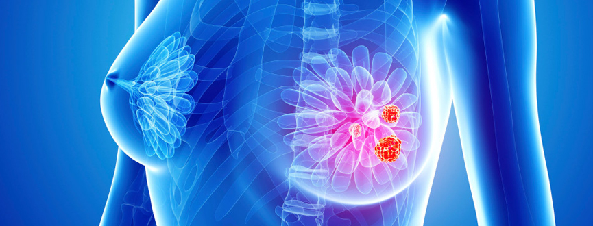 Breast Cancer in Dubai Breast Cancer Center In Gulf