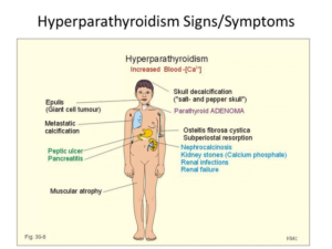 Symptoms of hyperparathyroidism