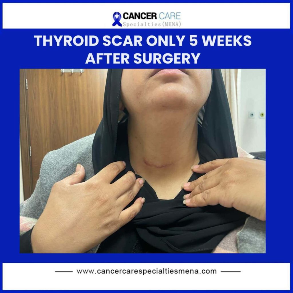 Thyroid scar only 5 weeks after surgery Cancer Care Center UAE